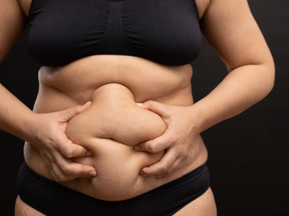 Abdominoplastika