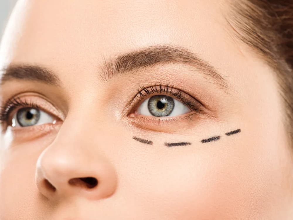Blefaroplastika