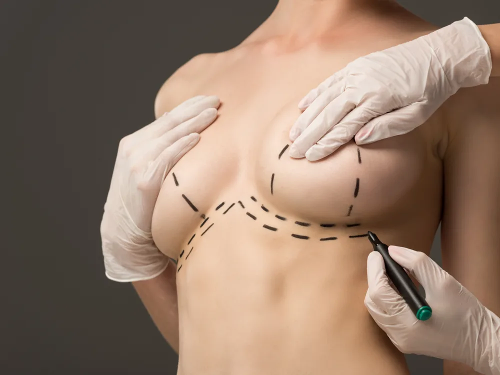 Mammoplastika